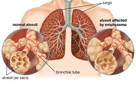 Study shows treatment for genetically caused emphysema is effective 